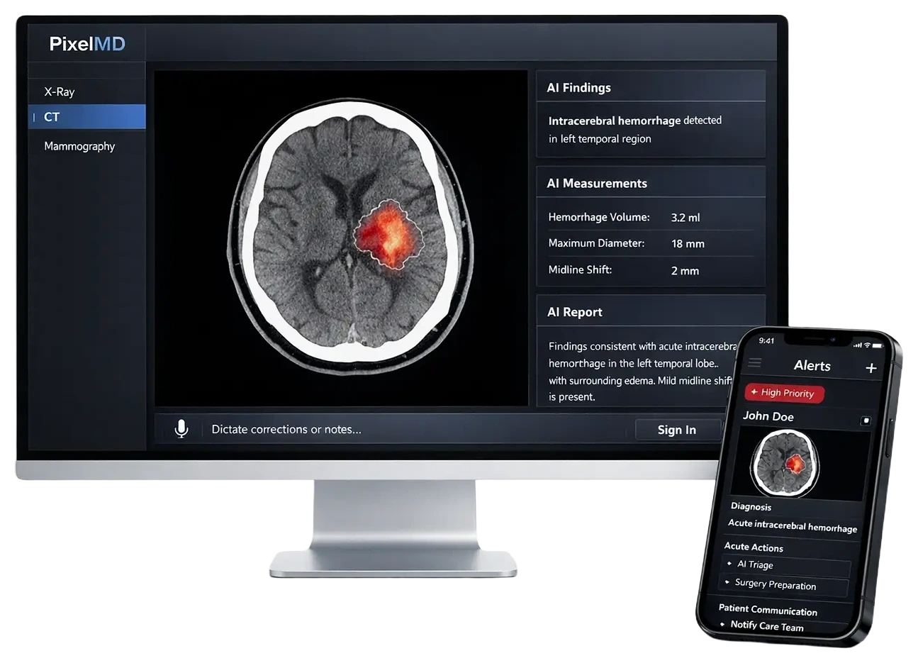 PixelMD radiology suite on a monitor and phone — AI findings, measurements and report for a CT scan