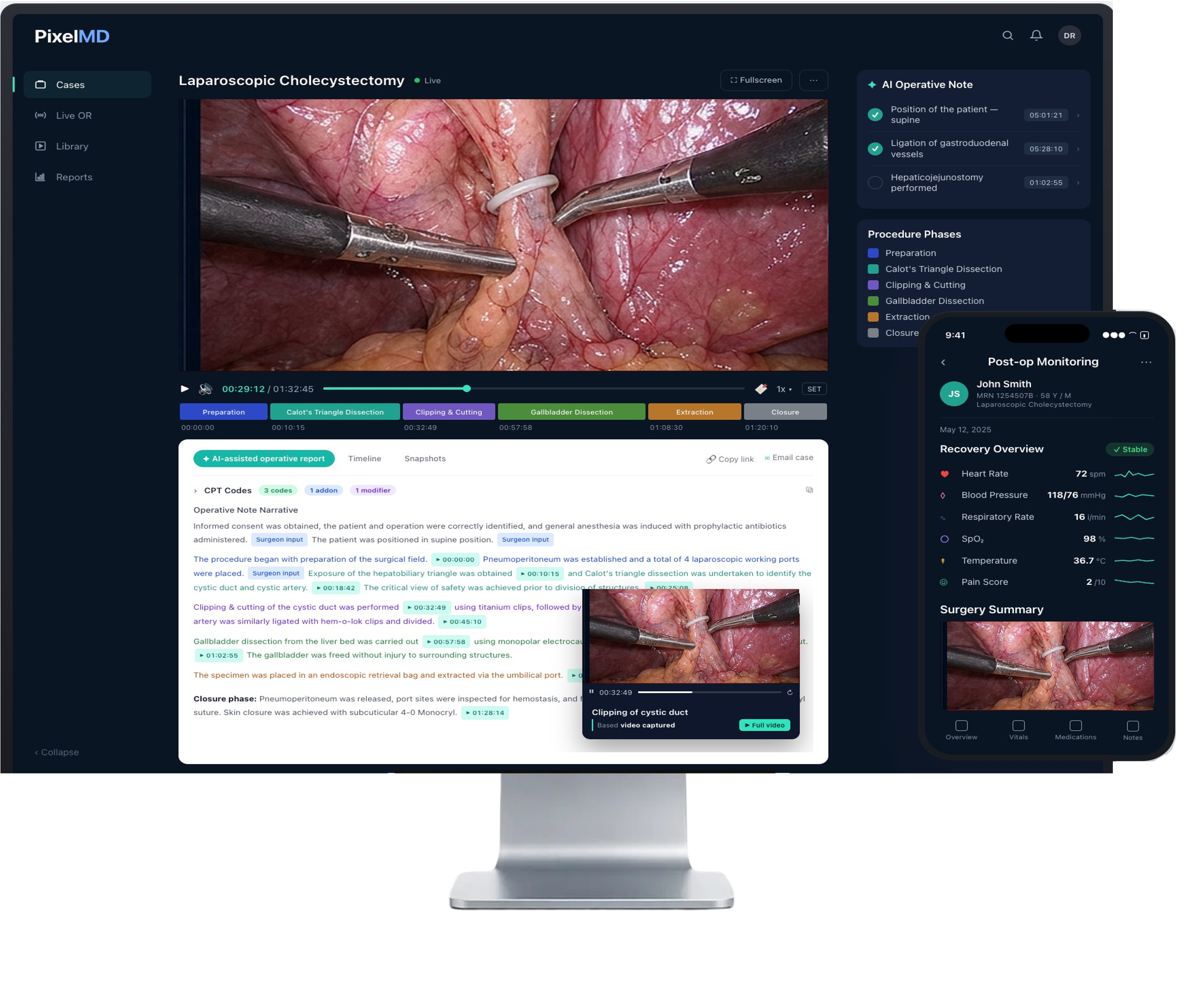 PixelMD surgery suite on a monitor and phone — AI operative note, procedure phases timeline and post-op monitoring